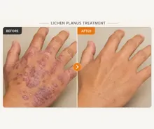 Lichen Planus before and after
