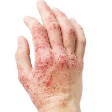 Eczema