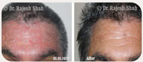 Psoriasis before and after homeopathic treatment