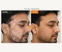 Vitiligo before and after