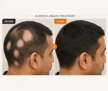 Alopecia Areata before and after